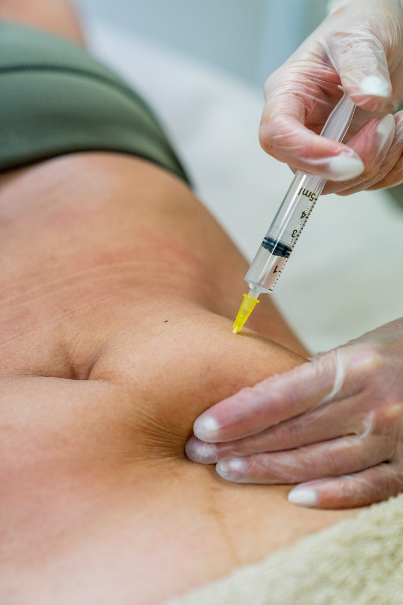 Bioestimulación Corporal Inyectable